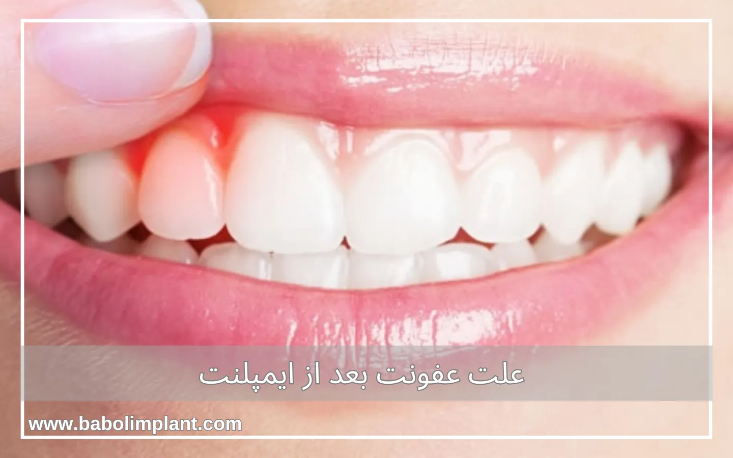 علت عفونت بعد از ایمپلنت
