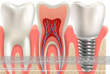 عوامل تاثیرگذار بر انتخاب سن مناسب برای ایمپلنت دندان