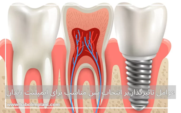 عوامل تاثیرگذار بر انتخاب سن مناسب برای ایمپلنت دندان