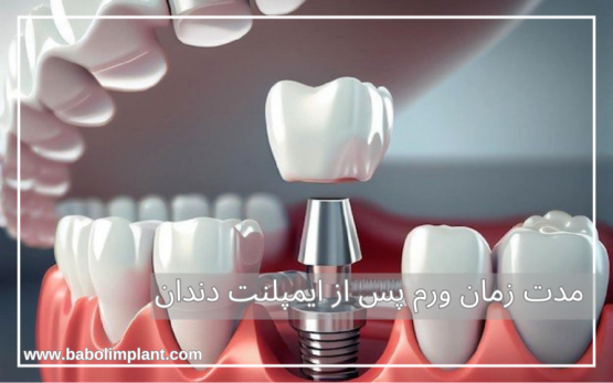 ورم بعد از ایمپلنت چند روز طول میکشد؟ + راهکار های درمانی