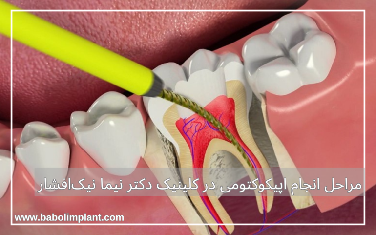 مراحل انجام اپیکوکتومی در کلینیک دکتر نیما نیک‌افشار