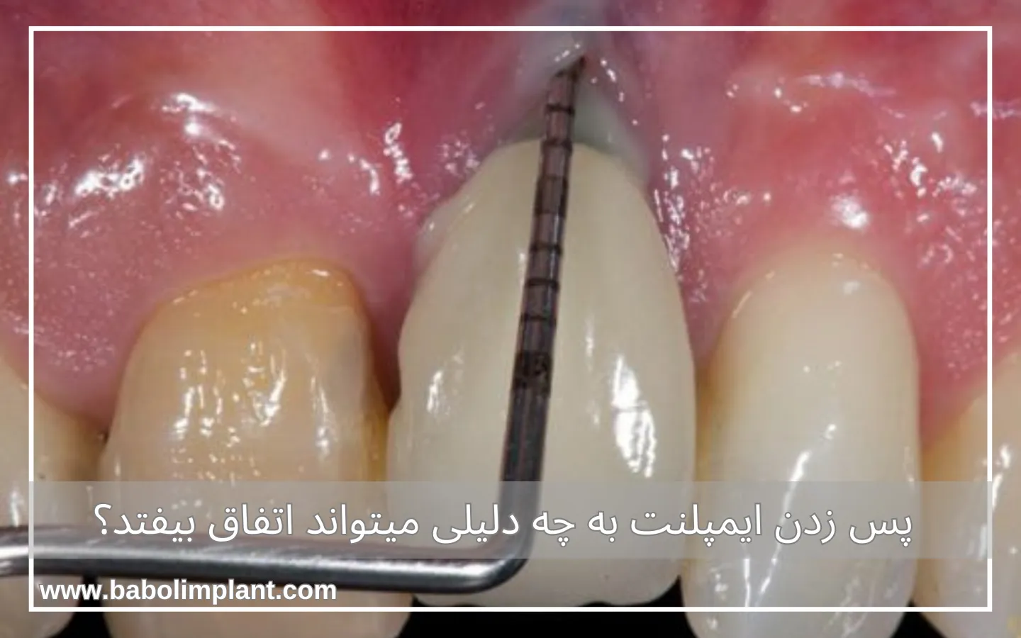 پس زدن ایمپلنت به چه دلیلی میتواند اتفاق بیفتد؟