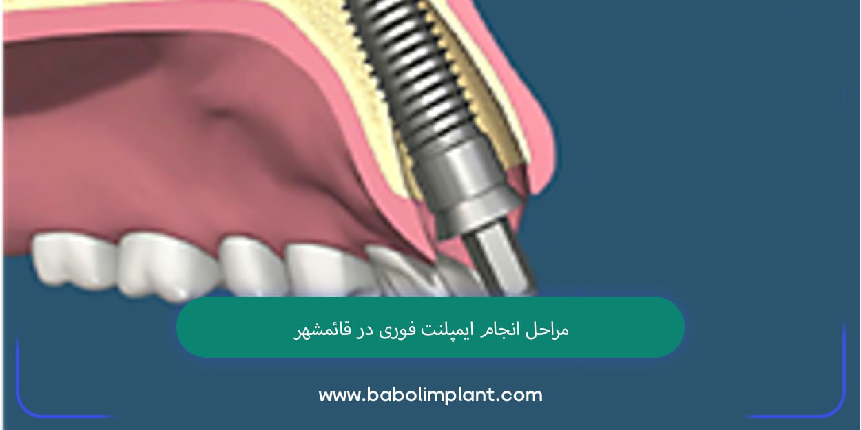 ایمپلنت فوری در قائشهر