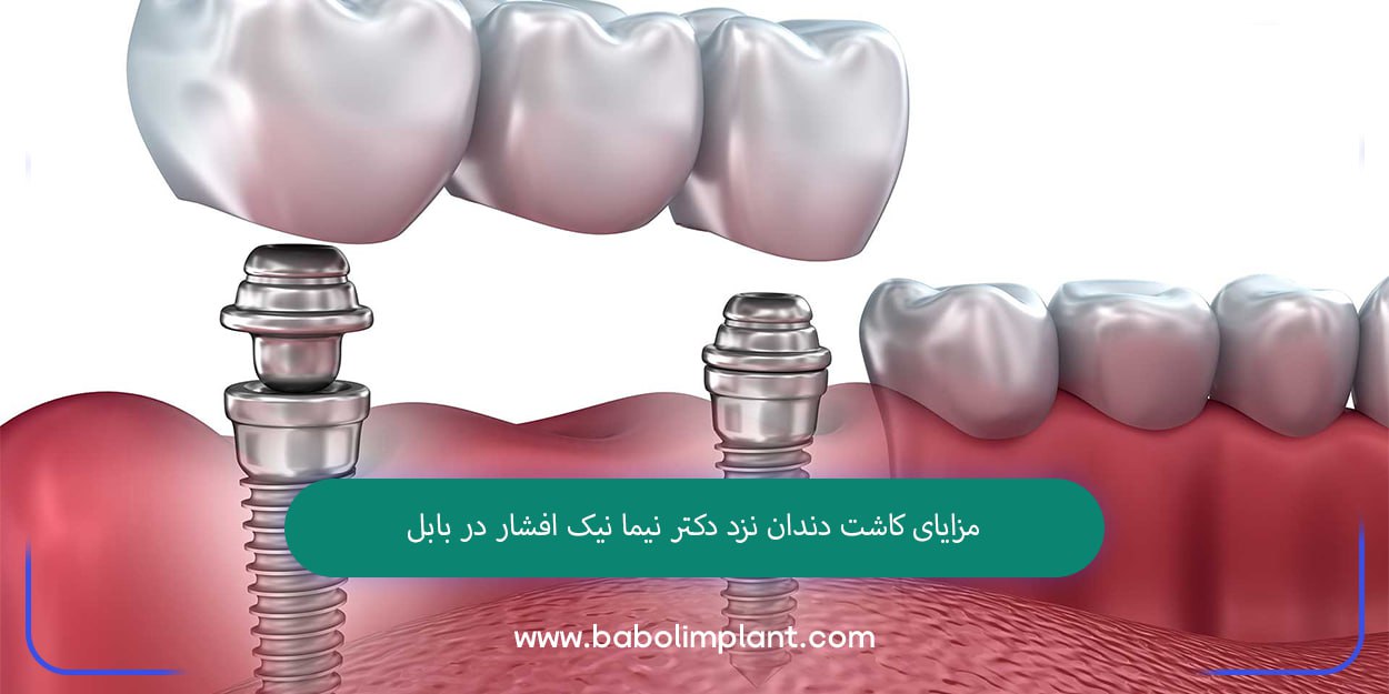 مزایای ایمپلنت در امل