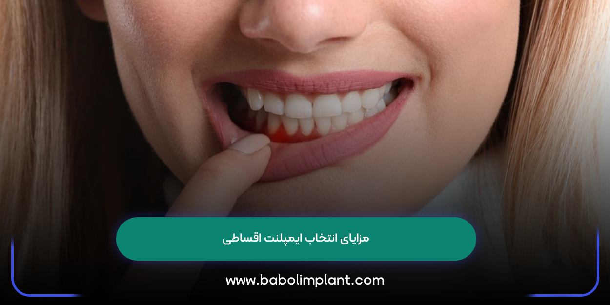 Benefits of choosing installment implants