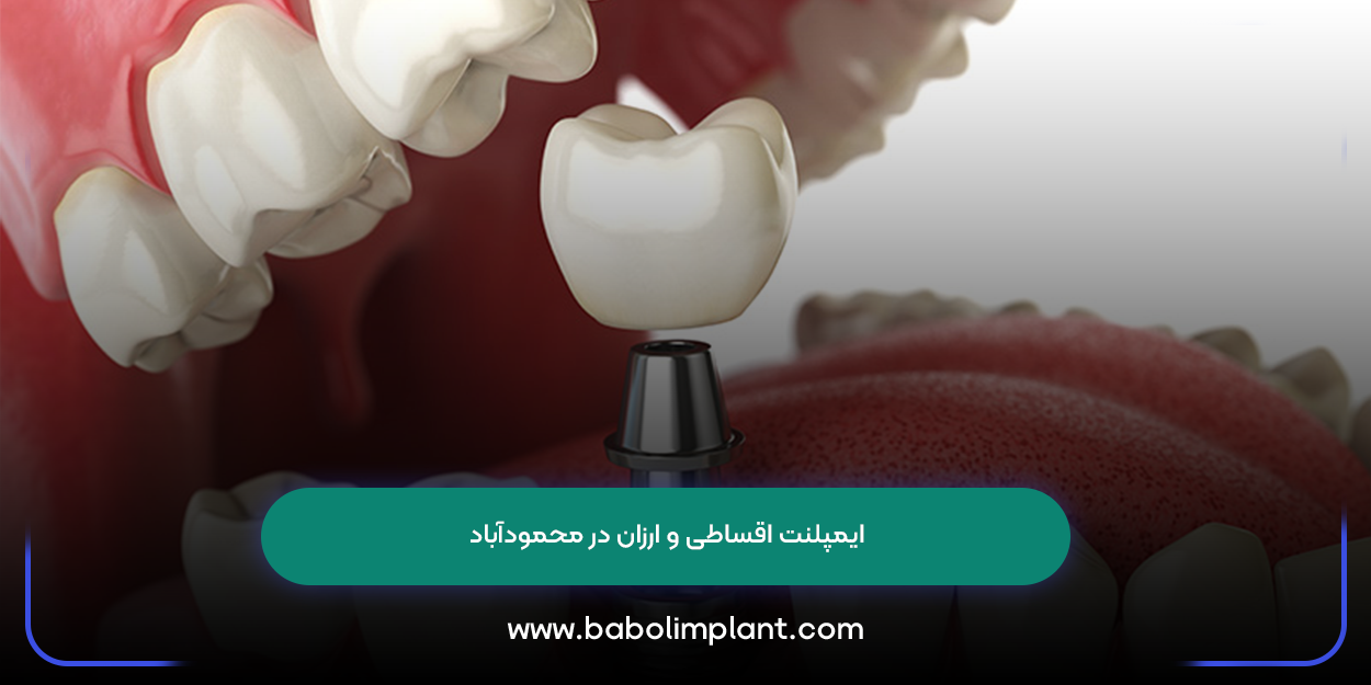Cheap and installment dental implants in Mahmudabad