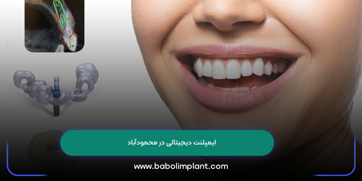 Digital Implant in Mahmudabad