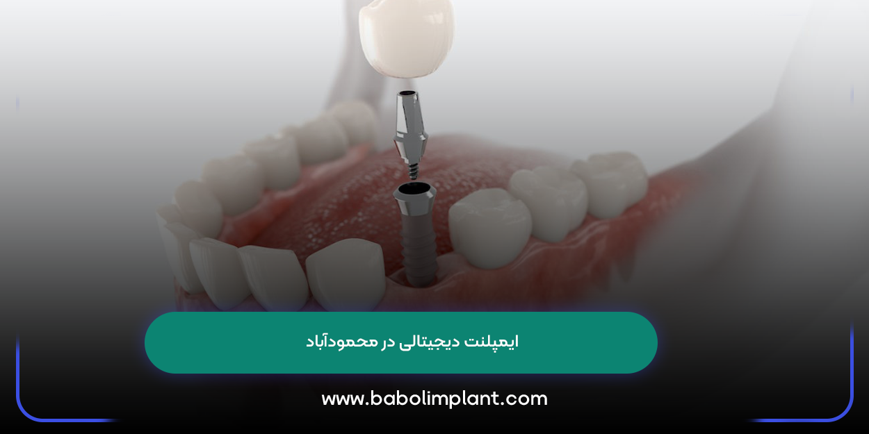 Digital Implant in Mahmudabad