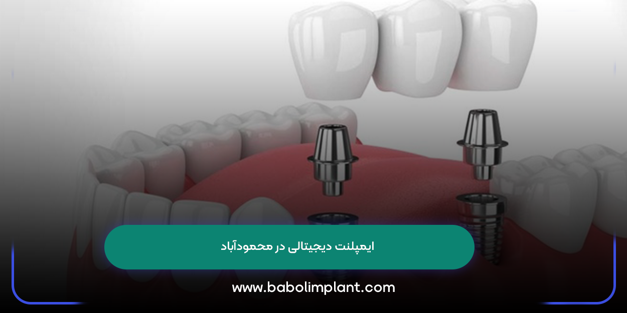 Digital Implant in Mahmudabad
