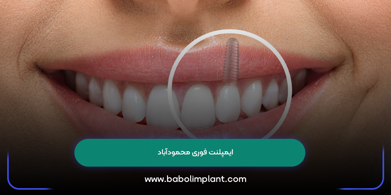 Immediate implants in Mahmudabad