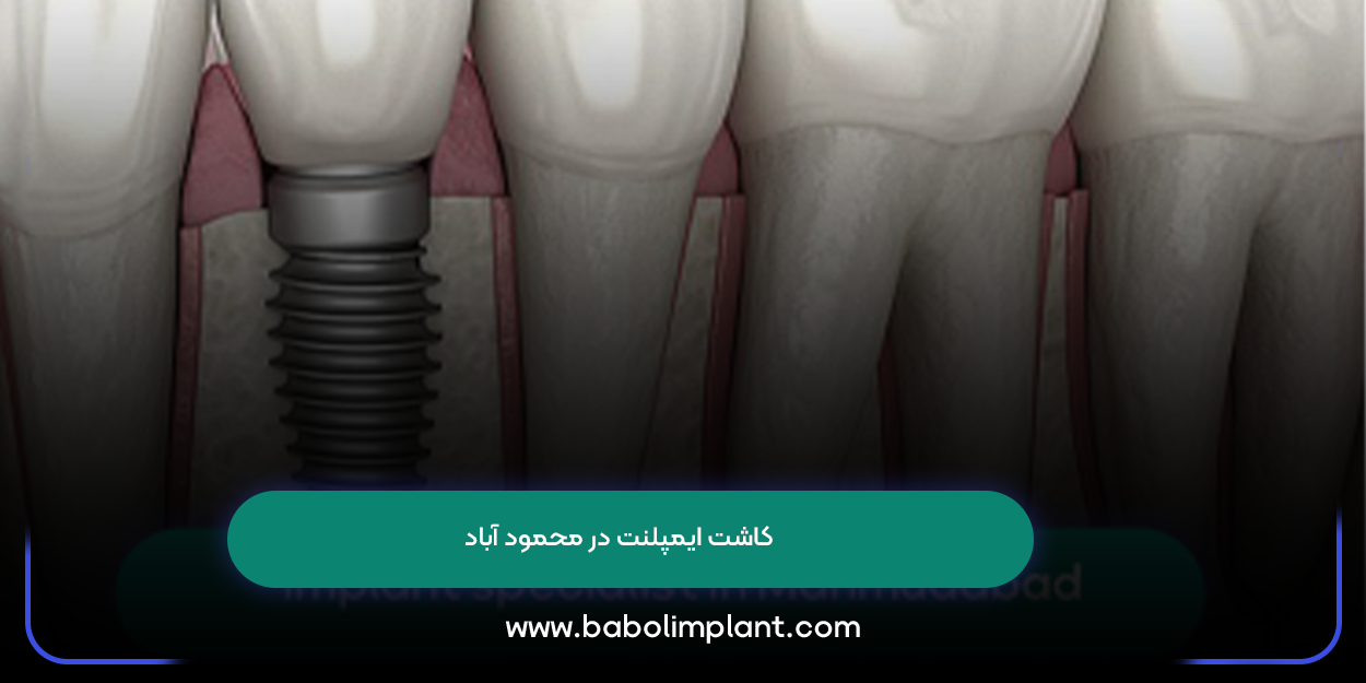 Implants in Mahmudabad