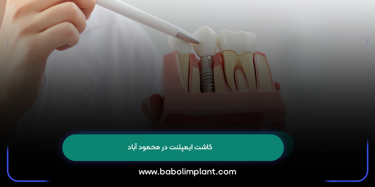 Implant placement in Mahmoudabad