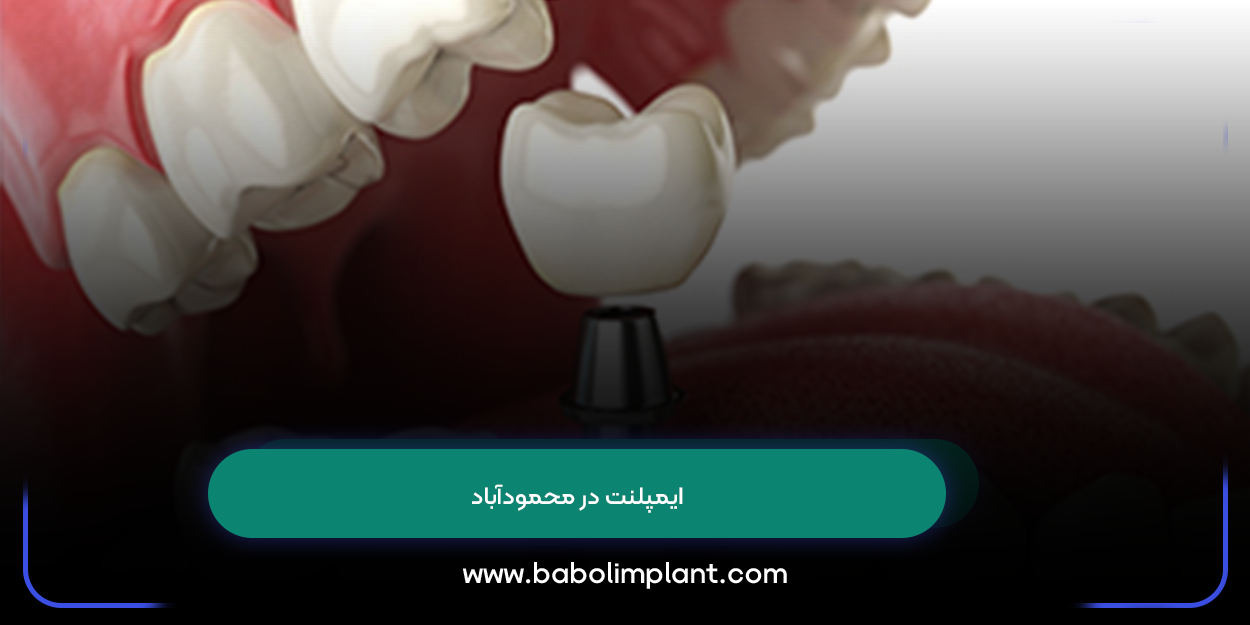 Implants in Mahmudabad