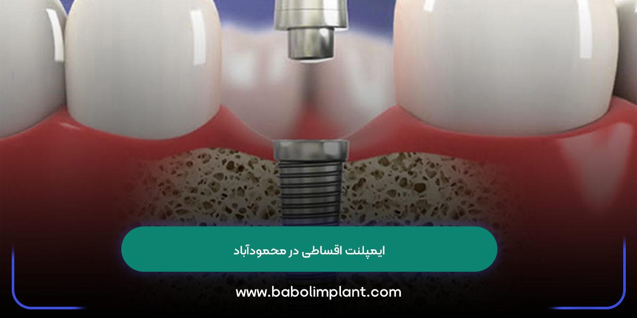 Installment implants in Mahmudabad