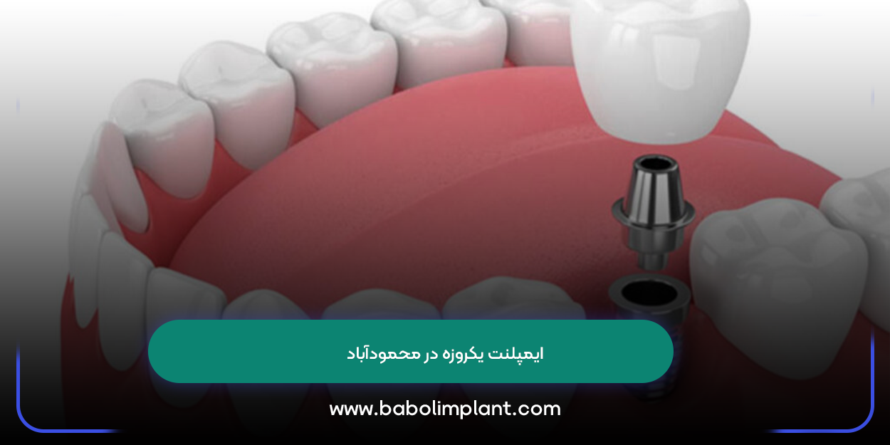 One-day implants in Mahmudabad