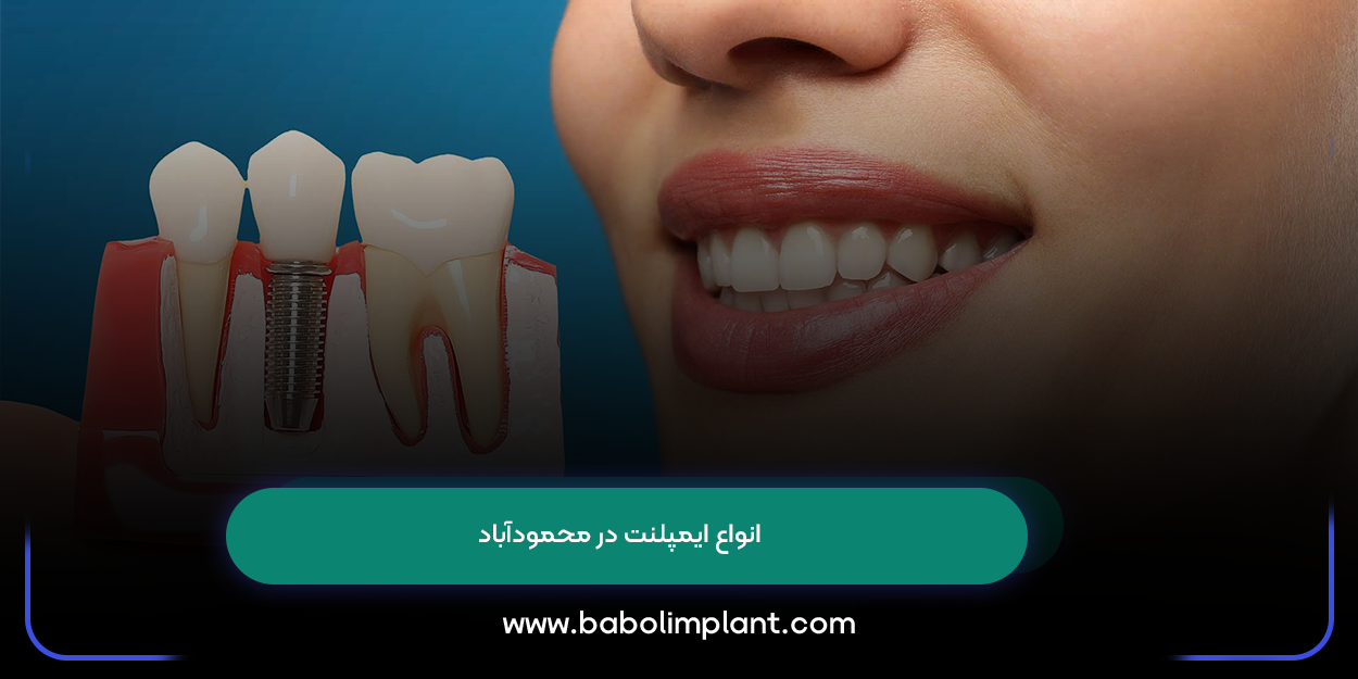 Types of implants in Mahmudabad