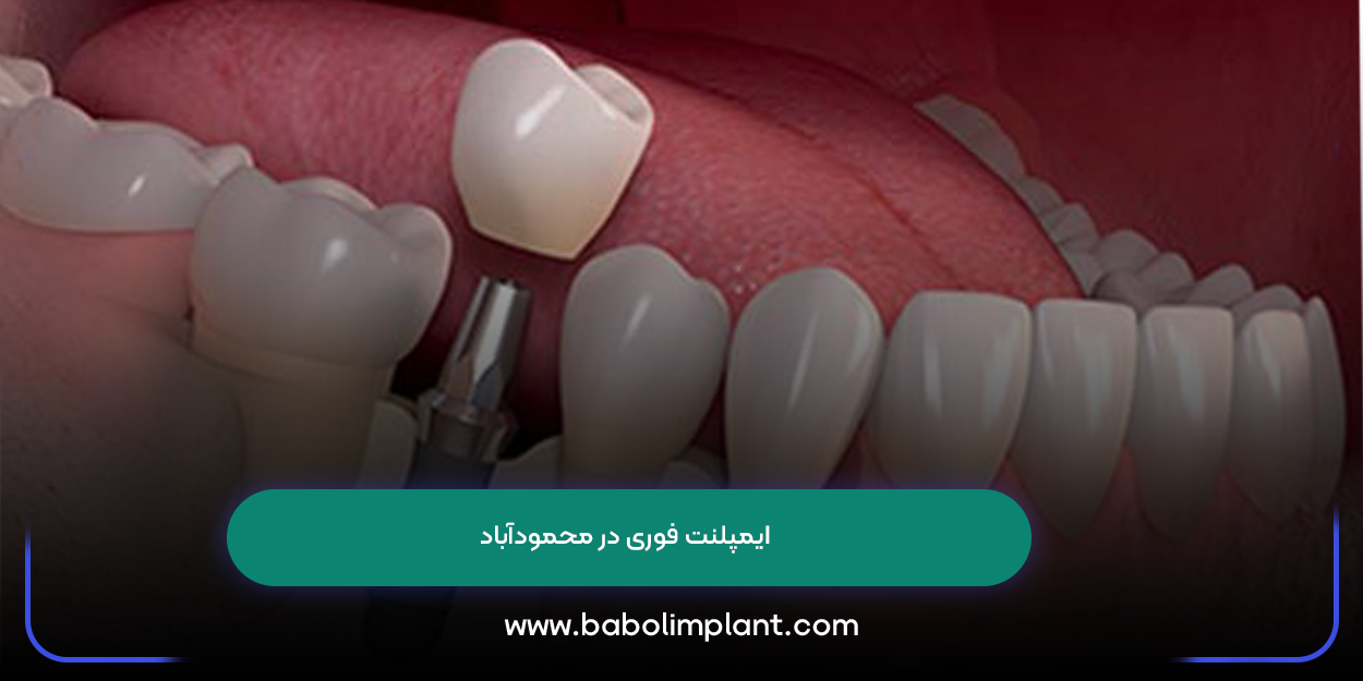 Urgent implants in Mahmudabad