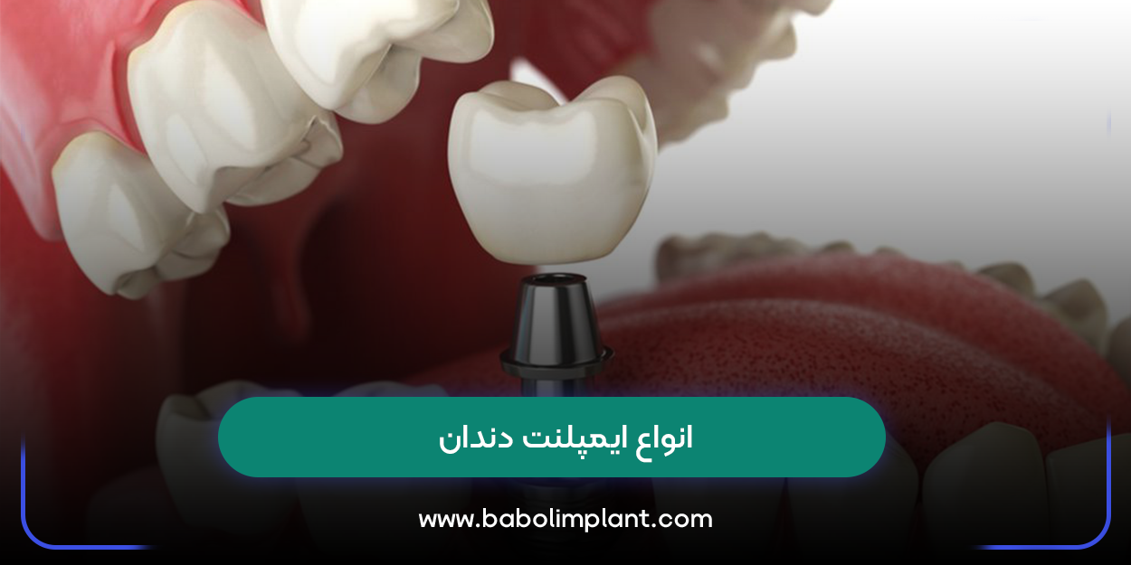 انواع ایمپلنت دندان