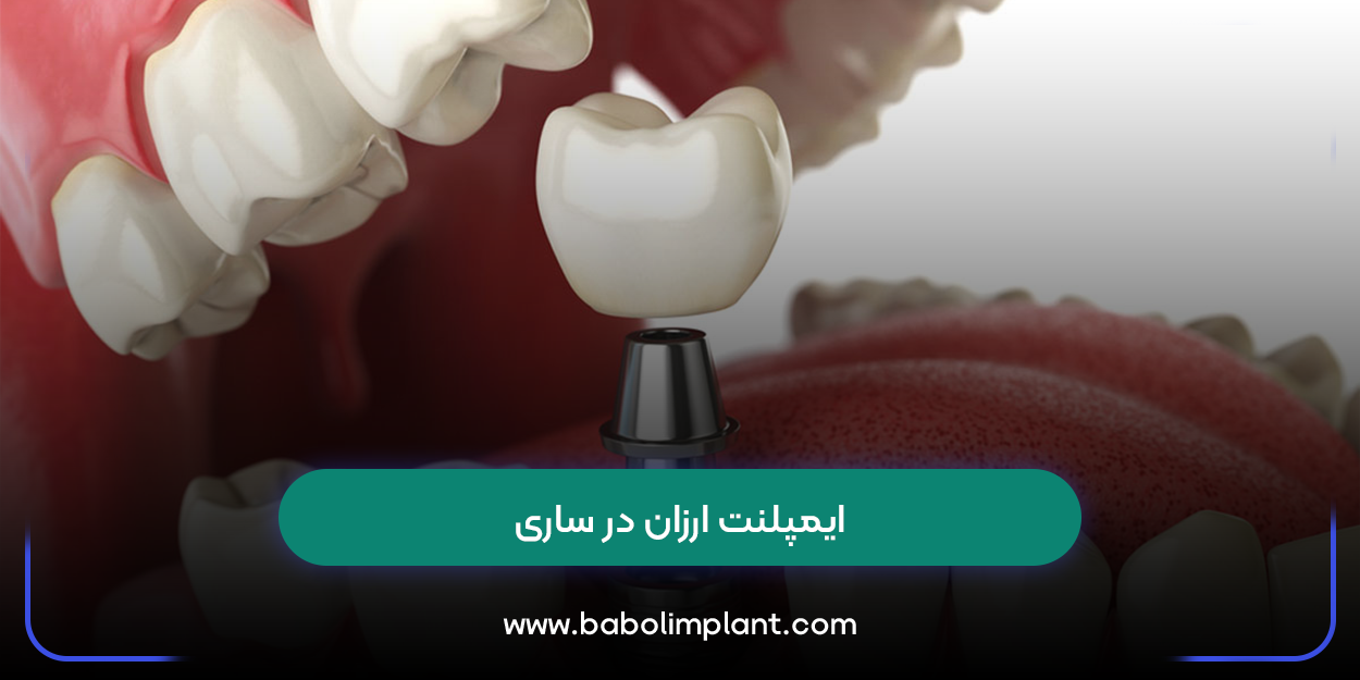 ایمپلنت ارزان در ساری