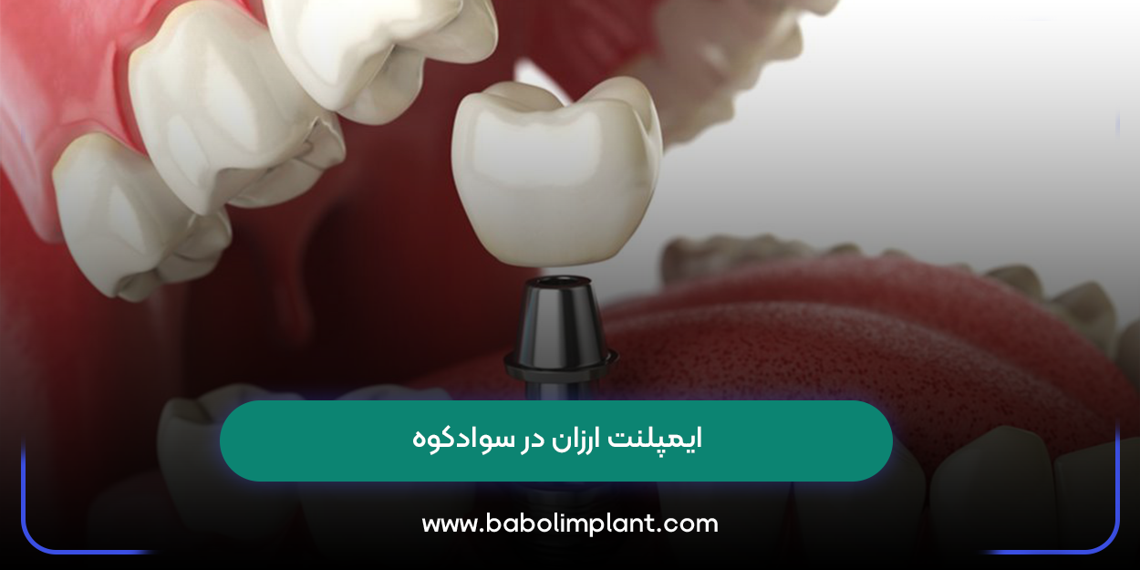 ایمپلنت ارزان در سوادکوه