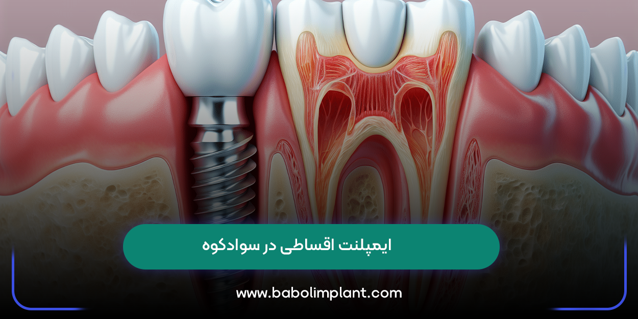 ایمپلنت اقساطی در سوادکوه