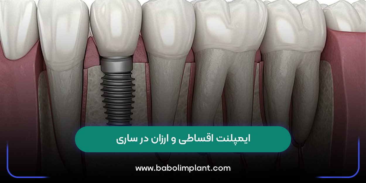 ایمپلنت اقساطی و ارزان در ساری
