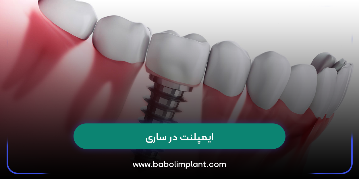 ایمپلنت در ساری