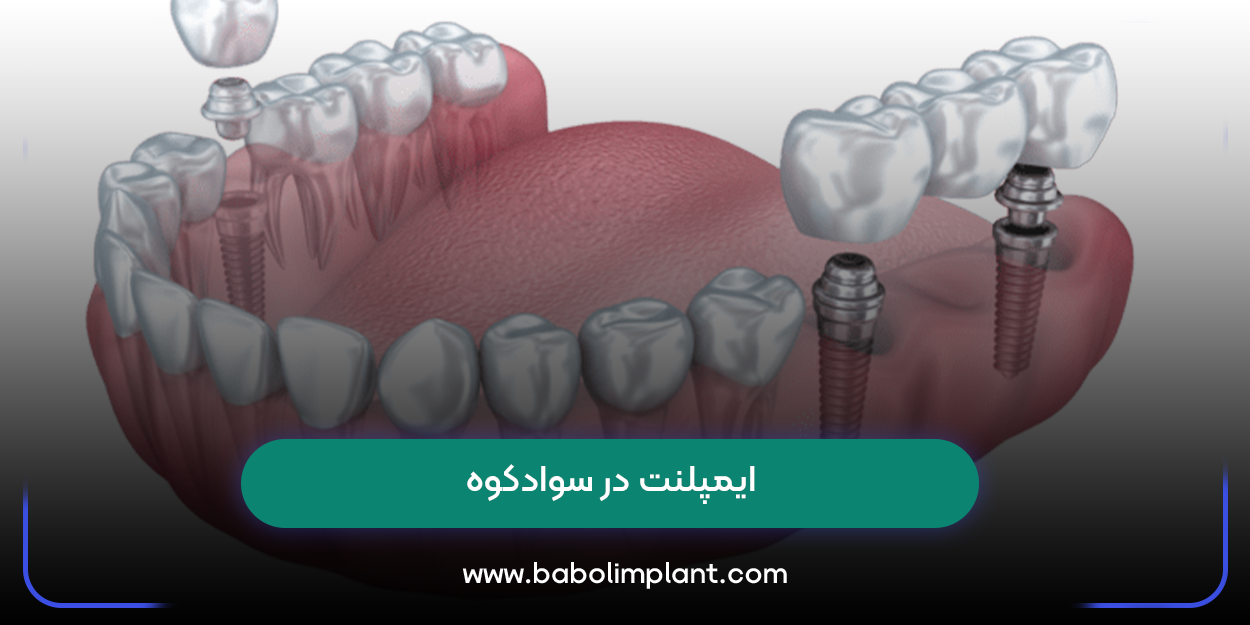 ایمپلنت در سوادکوه
