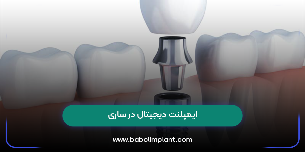 ایمپلنت دیجیتال در ساری 
