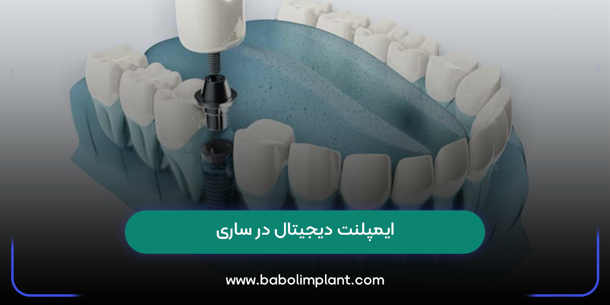 ایمپلنت دیجیتال در ساری