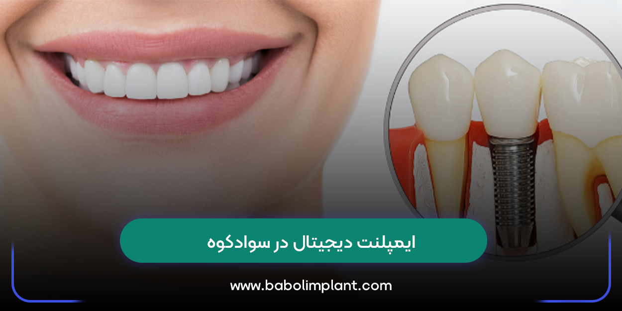 ایمپلنت دیجیتال در سوادکوه