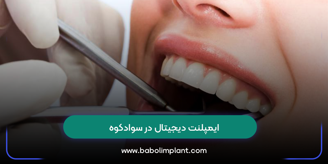 ایمپلنت دیجیتال در سوادکوه