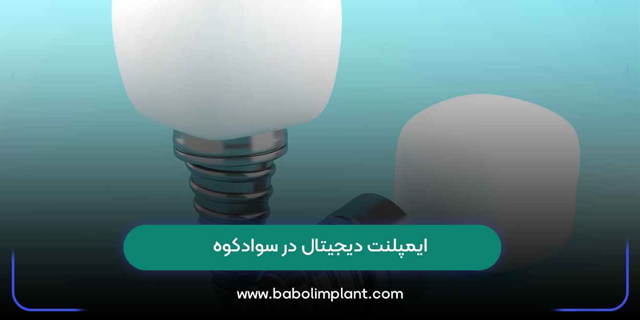 ایمپلنت دیجیتال در سوادکوه