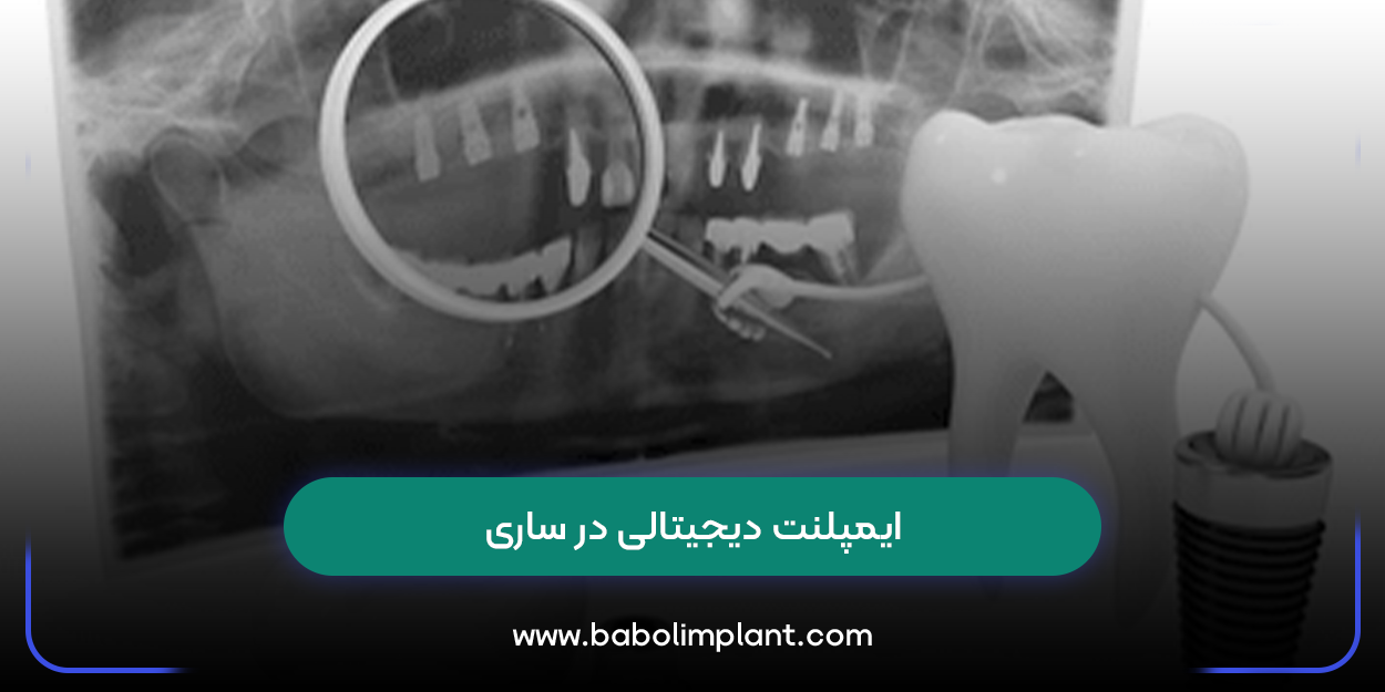 ایمپلنت دیجیتالی در ساری