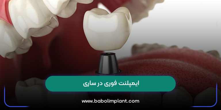ایمپلنت فوری در ساری