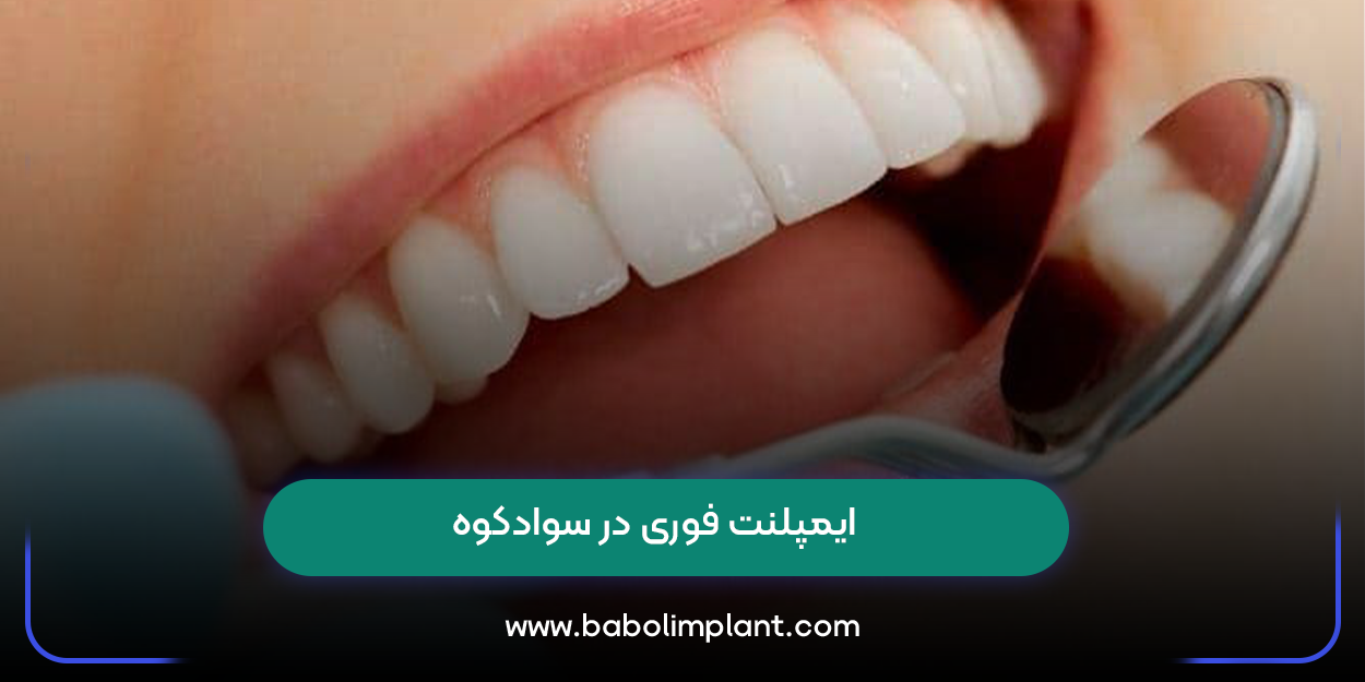 ایمپلنت فوری در سوادکوه