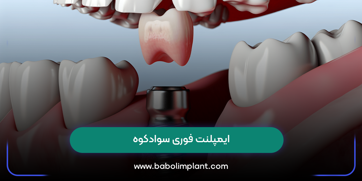 ایمپلنت فوری سوادکوه