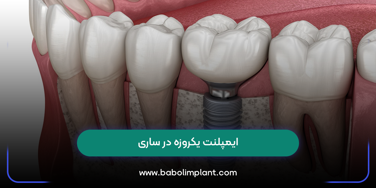 ایمپلنت یکروزه در ساری
