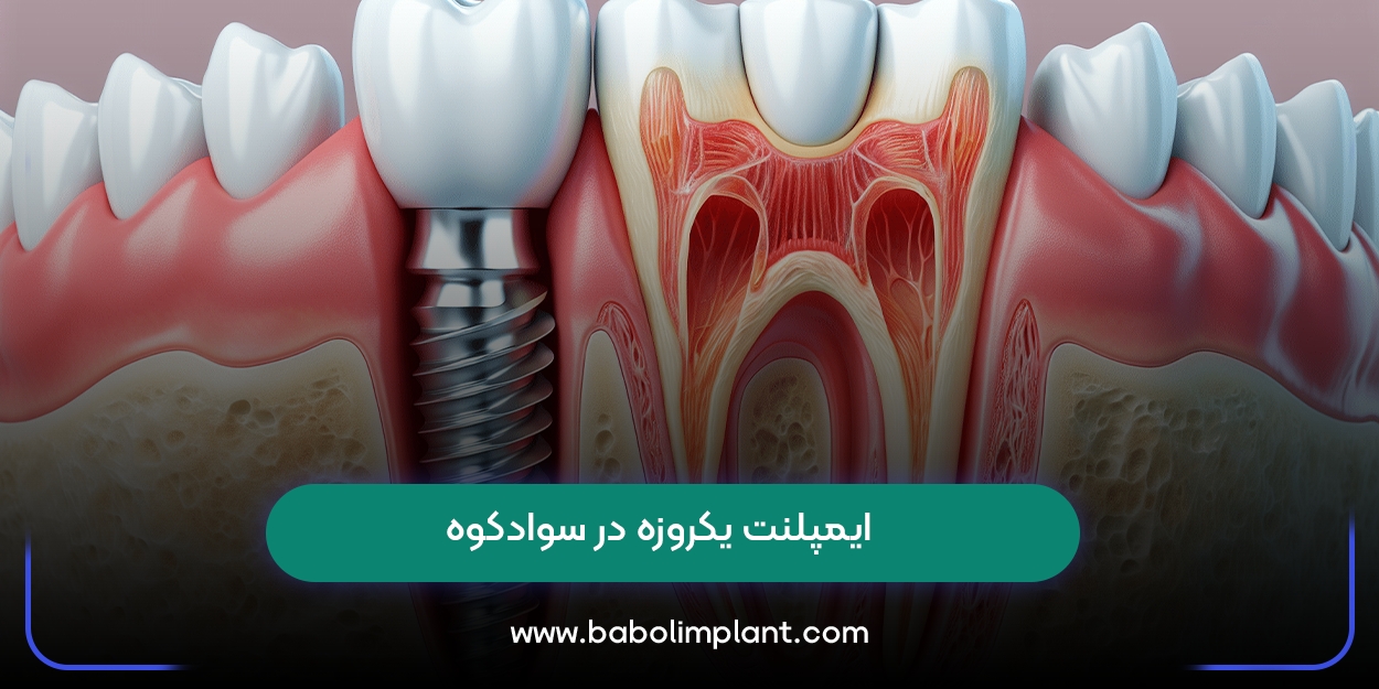 ایمپلنت یکروزه در سوادکوه