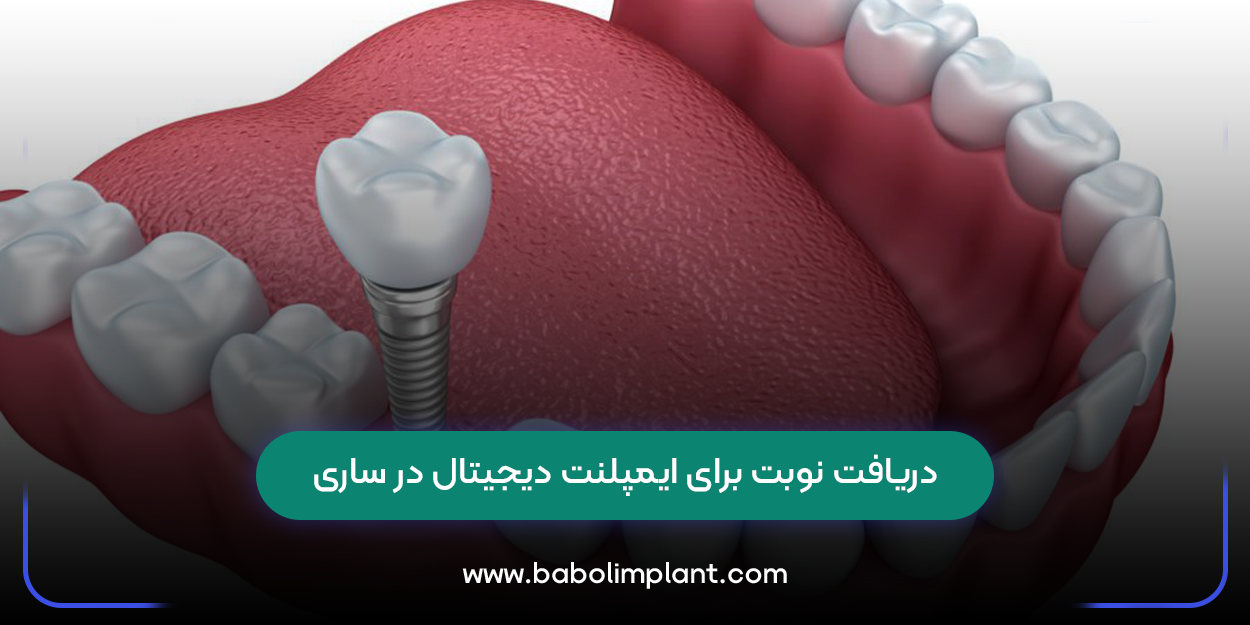 دریافت نوبت برای ایمپلنت دیجیتال در ساری