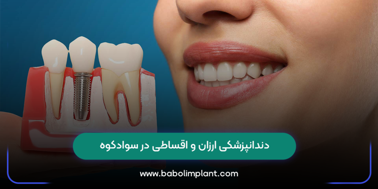 دندانپزشکی ارزان و اقساطی در سوادکوه