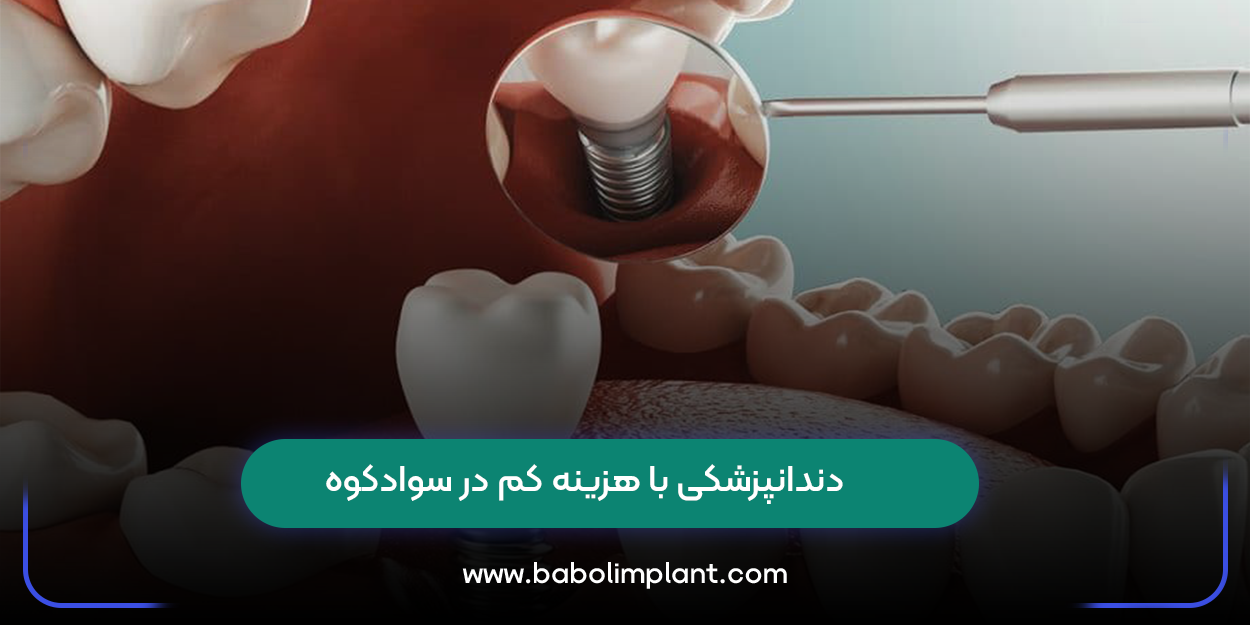 دندانپزشکی با هزینه کم در سوادکوه