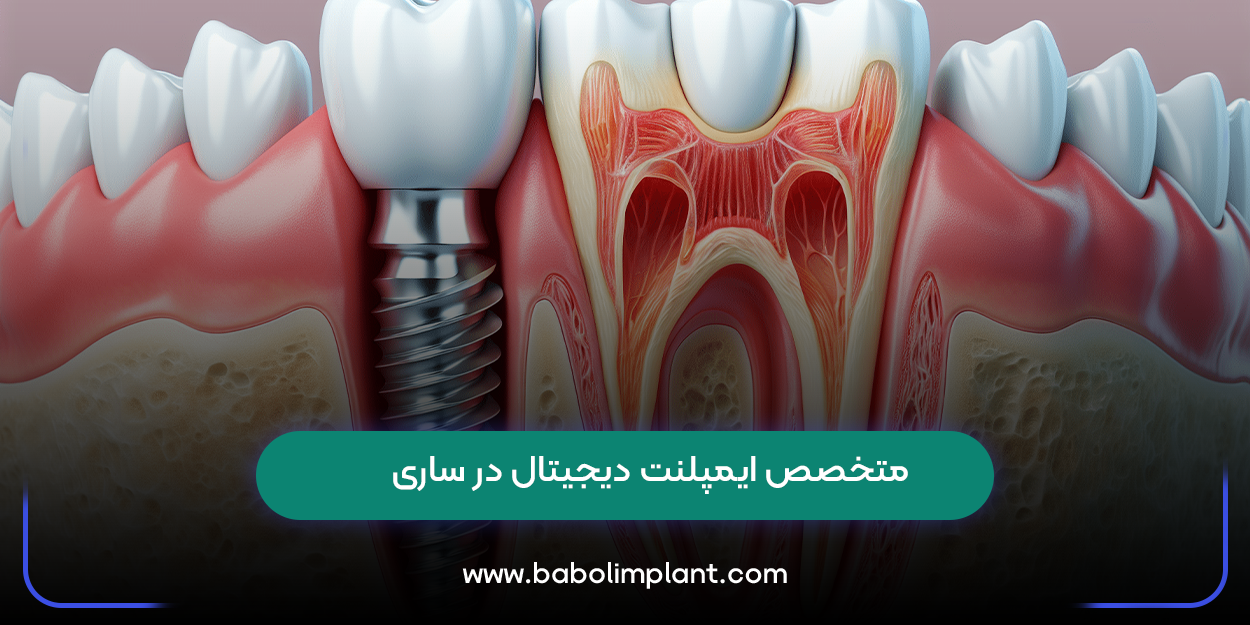 متخصص ایمپلنت دیجیتال در ساری