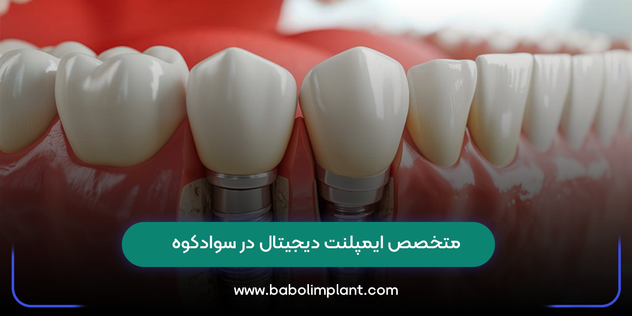 متخصص ایمپلنت دیجیتال در سوادکوه