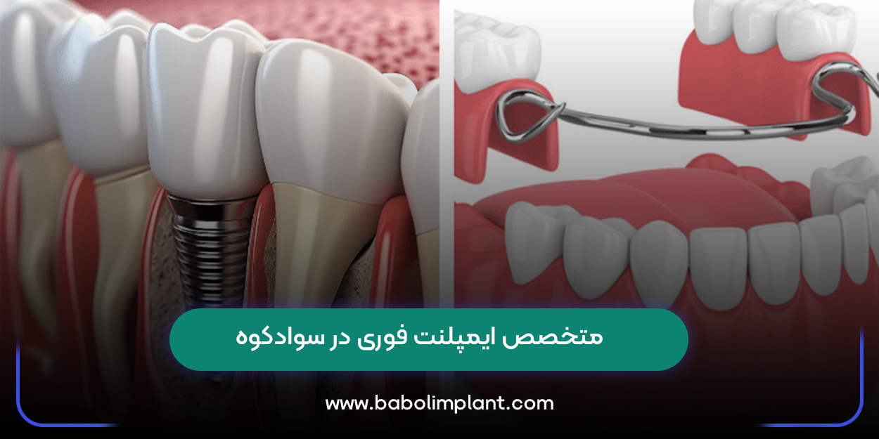 متخصص ایمپلنت فوری در سوادکوه