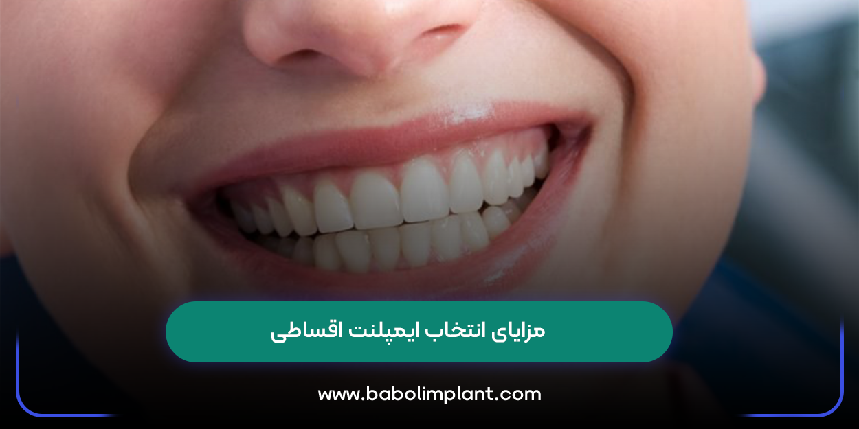 مزایای انتخاب ایمپلنت اقساطی