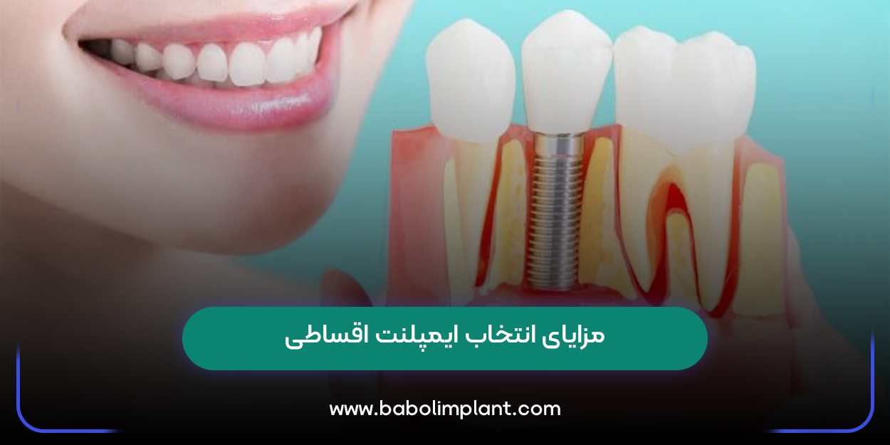 مزایای انتخاب ایمپلنت اقساطی