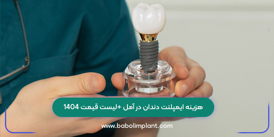 هزینه ایمپلنت دندان در آمل +لیست قیمت 1404