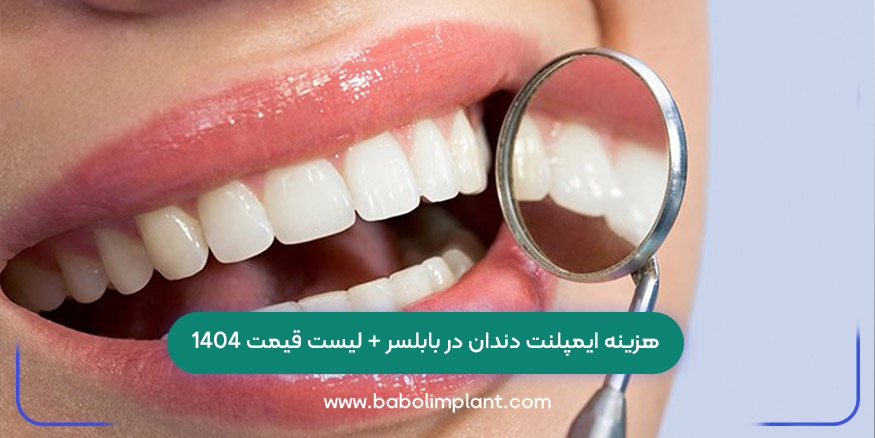 هزینه ایمپلنت دندان در بابلسر + لیست قیمت 1404