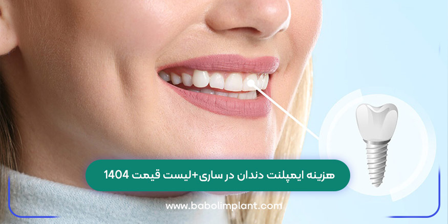 هزینه ایمپلنت دندان در ساری+لیست قیمت 1404